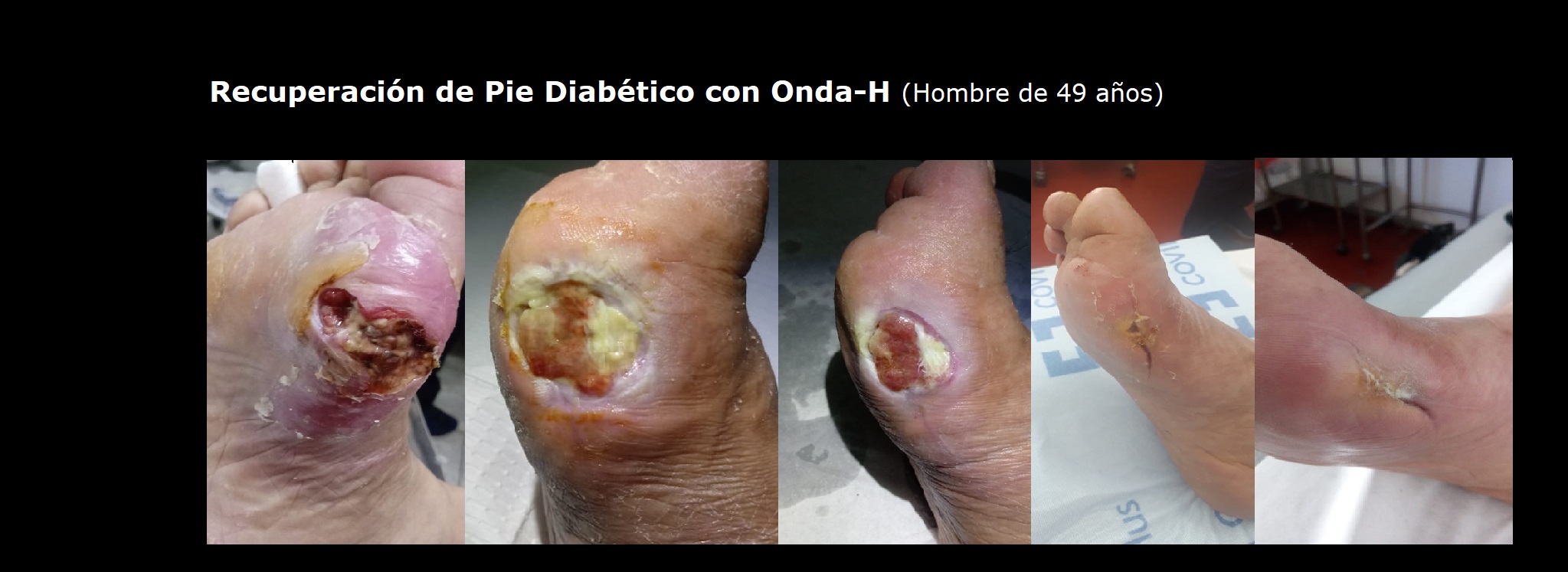 Secuencia de Recuperación de Pie Diabético